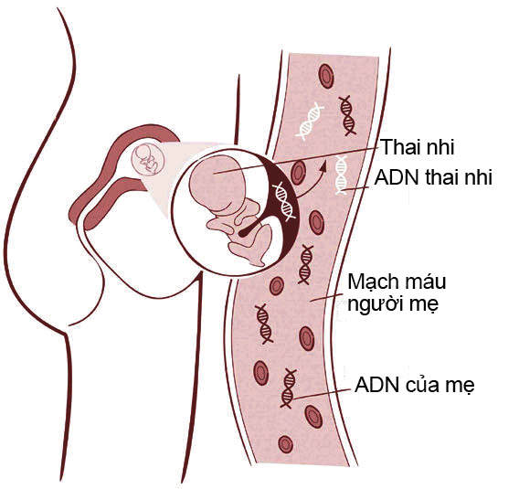 Xét nghiệm chẩn đoán và sàng lọc trước sinh không xâm lấn NIPT